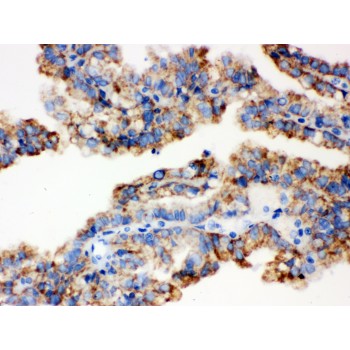 ALDH2 Antibody - ALDH2 antibody IHC-paraffin. IHC(P): Human Kidney Cancer Tissue.