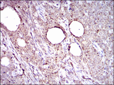 ALDH2 Antibody - IHC of paraffin-embedded cervical cancer tissues using ALDH2 mouse monoclonal antibody with DAB staining.