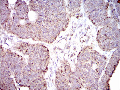 ALDH2 Antibody - IHC of paraffin-embedded rectum cancer tissues using ALDH2 mouse monoclonal antibody with DAB staining.