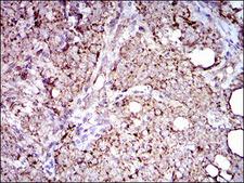 ALDH2 Antibody - IHC of paraffin-embedded cervical cancer tissues using ALDH2 mouse monoclonal antibody with DAB staining.