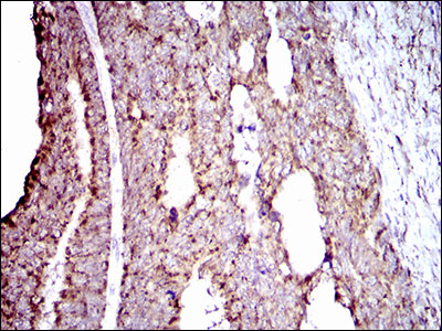 ALDH2 Antibody - IHC of paraffin-embedded rectum cancer tissues using ALDH2 mouse monoclonal antibody with DAB staining.