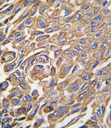 ALDH3A1 Antibody - Formalin-fixed and paraffin-embedded human lung carcinoma tissue reacted with ALDH3A1 antibody , which was peroxidase-conjugated to the secondary antibody, followed by DAB staining. This data demonstrates the use of this antibody for immunohistochemistry; clinical relevance has not been evaluated.