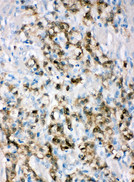 ALDH3A1 Antibody - ALDH3A1 antibody. IHC(P): Human Gastric Cancer Tissue.