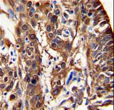 ALDH3A1 Antibody - Formalin-fixed and paraffin-embedded human lung carcinoma reacted with ALDH3A1 Antibody , which was peroxidase-conjugated to the secondary antibody, followed by DAB staining. This data demonstrates the use of this antibody for immunohistochemistry; clinical relevance has not been evaluated.