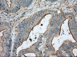 ALDH3A1 Antibody - IHC of paraffin-embedded Adenocarcinoma of colon tissue using anti-ALDH3A1 mouse monoclonal antibody. (Dilution 1:50).