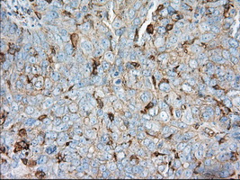 ALDH3A1 Antibody - IHC of paraffin-embedded Adenocarcinoma of ovary tissue using anti-ALDH3A1 mouse monoclonal antibody. (Dilution 1:50).