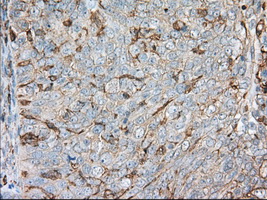 ALDH3A1 Antibody - IHC of paraffin-embedded Adenocarcinoma of ovary tissue using anti-ALDH3A1 mouse monoclonal antibody. (Dilution 1:50).