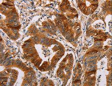 ALDH3A1 Antibody - Immunohistochemistry of paraffin-embedded Human gastric cancer using ALDH3A1 Polyclonal Antibody at dilution of 1:55.