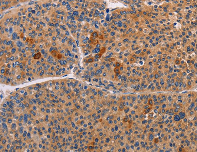 ALDH3A1 Antibody - Immunohistochemistry of paraffin-embedded Human liver cancer using ALDH3A1 Polyclonal Antibody at dilution of 1:55.