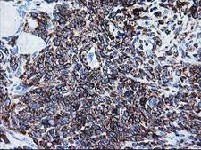 ALDH3A2 Antibody - IHC of paraffin-embedded Adenocarcinoma of Human breast tissue using anti-ALDH3A2 mouse monoclonal antibody. (Heat-induced epitope retrieval by 10mM citric buffer, pH6.0, 100C for 10min).