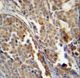 ALDH3A2 Antibody - ALDH3A2 Monoclonal Antibody (Ascites) immunohistochemistry of formalin-fixed and paraffin-embedded human skin carcinoma followed by peroxidase-conjugated secondary antibody and DAB staining. This data demonstrates the use of the ALDH3A2 Monoclonal Antibody (Ascites) for immunohistochemistry.