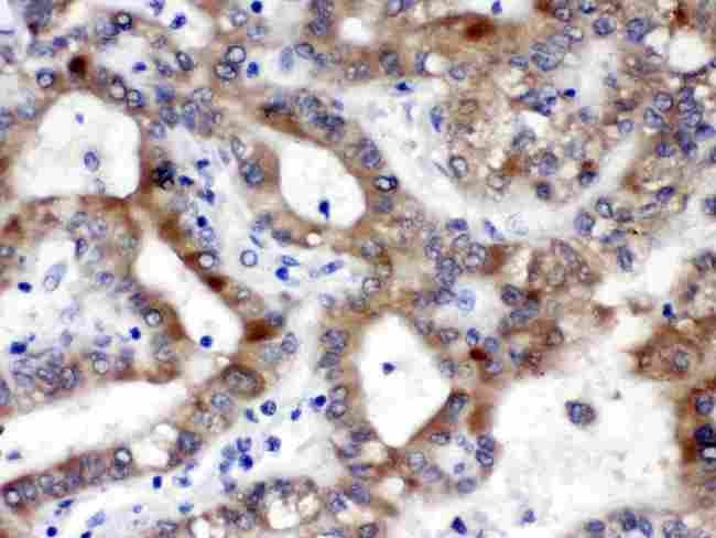 ALDH3A2 Antibody - ALDH3A2 was detected in paraffin-embedded sections of human liver cancer tissues using rabbit anti- ALDH3A2 Antigen Affinity purified polyclonal antibody