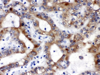 ALDH3A2 Antibody - IHC testing of FFPE human liver cancer tissue with ALDH3A2 antibody at 1ug/ml. HIER: steam in pH6 citrate buffer and allow to cool prior to staining.
