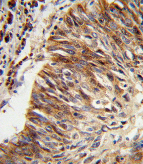 ALDH3B1 Antibody - Formalin-fixed and paraffin-embedded human lung carcinoma reacted with ALDH3B1 Antibody , which was peroxidase-conjugated to the secondary antibody, followed by DAB staining. This data demonstrates the use of this antibody for immunohistochemistry; clinical relevance has not been evaluated.