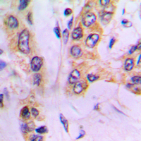 ALDH3B1 Antibody - Immunohistochemical analysis of ALDH3B1 staining in human lung cancer formalin fixed paraffin embedded tissue section. The section was pre-treated using heat mediated antigen retrieval with sodium citrate buffer (pH 6.0). The section was then incubated with the antibody at room temperature and detected using an HRP conjugated compact polymer system. DAB was used as the chromogen. The section was then counterstained with hematoxylin and mounted with DPX. w