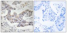 ALDH3B1 Antibody - Peptide - + Immunohistochemistry analysis of paraffin-embedded human breast carcinoma tissue, using ALDH3B1 antibody.