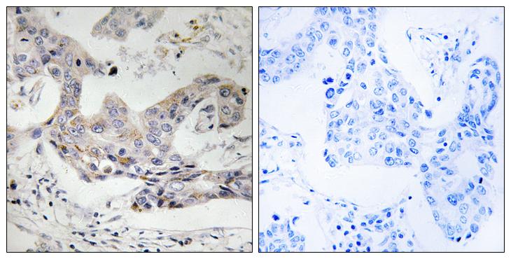 ALDH3B1 Antibody - Peptide - + Immunohistochemistry analysis of paraffin-embedded human breast carcinoma tissue, using ALDH3B1 antibody.
