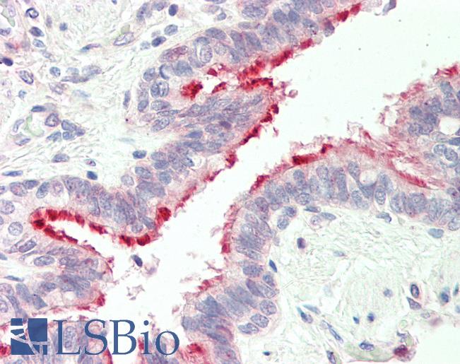 ALDH3B1 Antibody - Human, Lung: Formalin-Fixed Paraffin-Embedded (FFPE).  This image was taken for the unconjugated form of this product. Other forms have not been tested.