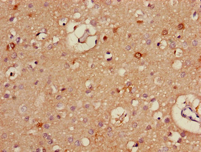 ALDH5A1 Antibody - IHC image of ALDH5A1 Antibody diluted at 1:400 and staining in paraffin-embedded human liver cancer performed on a Leica BondTM system. After dewaxing and hydration, antigen retrieval was mediated by high pressure in a citrate buffer (pH 6.0). Section was blocked with 10% normal goat serum 30min at RT. Then primary antibody (1% BSA) was incubated at 4°C overnight. The primary is detected by a biotinylated secondary antibody and visualized using an HRP conjugated SP system.