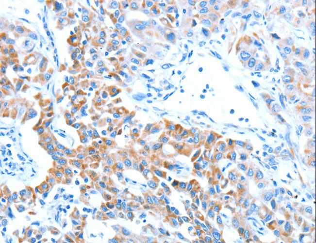 ALDH5A1 Antibody - Immunohistochemistry of paraffin-embedded Human lung cancer using ALDH5A1 Polyclonal Antibody at dilution of 1:60.