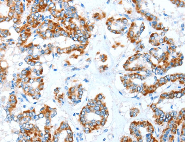 ALDH5A1 Antibody - Immunohistochemistry of paraffin-embedded Human colon cancer using ALDH5A1 Polyclonal Antibody at dilution of 1:35.