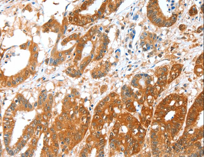ALDH5A1 Antibody - Immunohistochemistry of paraffin-embedded Human colon cancer using ALDH5A1 Polyclonal Antibody at dilution of 1:35.