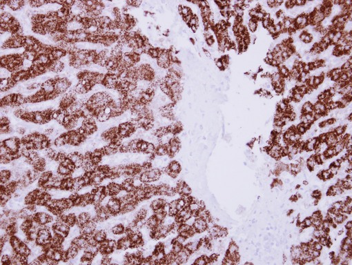 ALDH6A1 Antibody - IHC of paraffin-embedded Breast ca, using ALDH6A1 antibody at 1:250 dilution.