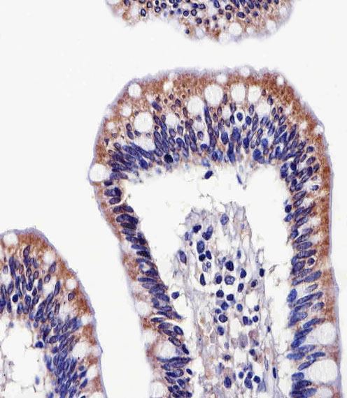 ALDH6A1 Antibody - Immunohistochemical of paraffin-embedded H.colon section using ALDH6A1 Antibody. Antibody was diluted at 1:25 dilution. A peroxidase-conjugated goat anti-rabbit IgG at 1:400 dilution was used as the secondary antibody, followed by DAB staining.