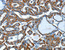 ALDH6A1 Antibody - Immunohistochemistry of paraffin-embedded Human thyroid cancer using ALDH6A1 Polyclonal Antibody at dilution of 1:45.