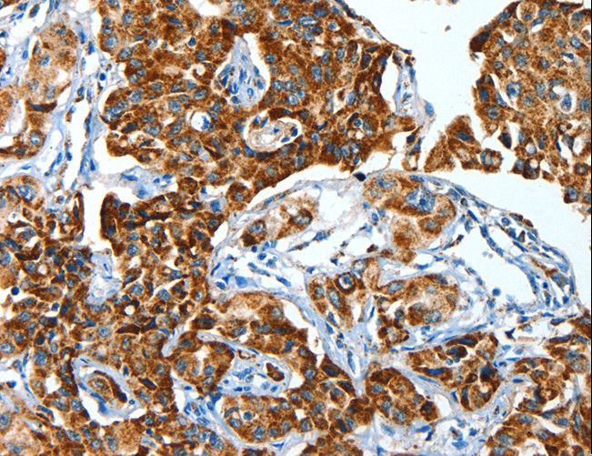 ALDH6A1 Antibody - Immunohistochemistry of paraffin-embedded Human lung cancer using ALDH6A1 Polyclonal Antibody at dilution of 1:45.