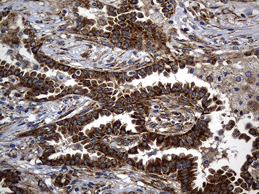 ALDH7A1 Antibody - Immunohistochemical staining of paraffin-embedded Carcinoma of Human lung tissue using anti-ALDH7A1 mouse monoclonal antibody. (Heat-induced epitope retrieval by 1mM EDTA in 10mM Tris buffer. (pH8.5) at 120°C for 3 min. (1:2000)