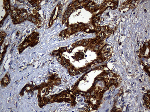 ALDH7A1 Antibody - Immunohistochemical staining of paraffin-embedded Carcinoma of Human liver tissue using anti-ALDH7A1 mouse monoclonal antibody. (Heat-induced epitope retrieval by 1mM EDTA in 10mM Tris buffer. (pH8.5) at 120°C for 3 min. (1:2000)