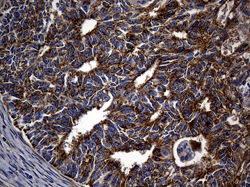 ALDH7A1 Antibody - Immunohistochemical staining of paraffin-embedded Adenocarcinoma of Human endometrium tissue using anti-ALDH7A1 mouse monoclonal antibody. (Heat-induced epitope retrieval by 1mM EDTA in 10mM Tris buffer. (pH8.5) at 120°C for 3 min. (1:2000)