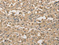 ALDH8A1 Antibody - Immunohistochemistry of paraffin-embedded Human thyroid cancer using ALDH8A1 Polyclonal Antibody at dilution of 1:30.
