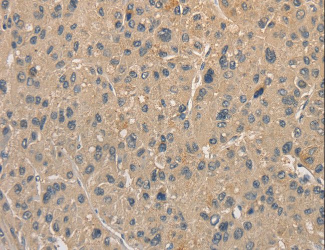 ALDH8A1 Antibody - Immunohistochemistry of paraffin-embedded Human liver cancer using ALDH8A1 Polyclonal Antibody at dilution of 1:40.