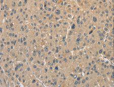 ALDH8A1 Antibody - Immunohistochemistry of paraffin-embedded Human liver cancer using ALDH8A1 Polyclonal Antibody at dilution of 1:40.