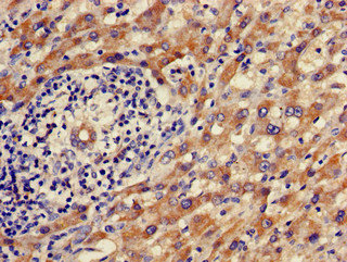 ALDH9A1 Antibody - Immunohistochemistry of paraffin-embedded human liver cancer using ALDH9A1 Antibody at dilution of 1:100