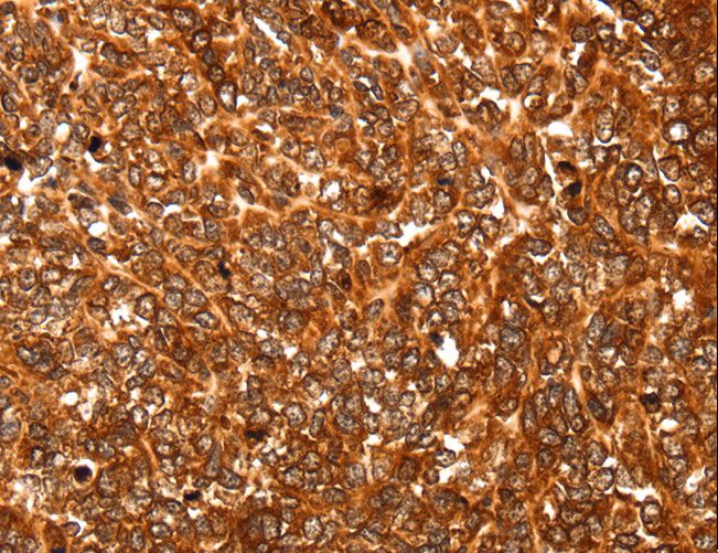 ALDOA / Aldolase A Antibody - Immunohistochemistry of paraffin-embedded Human ovarian cancer using ALDOA Polyclonal Antibody at dilution of 1:30.