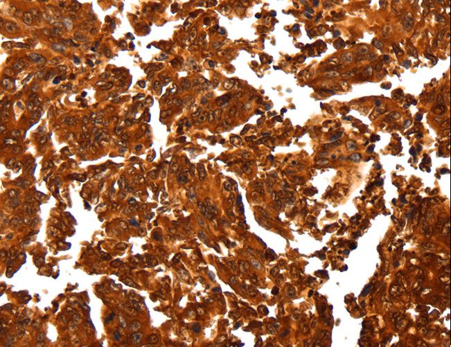 ALDOA / Aldolase A Antibody - Immunohistochemistry of paraffin-embedded Human gastric cancer using ALDOA Polyclonal Antibody at dilution of 1:30.