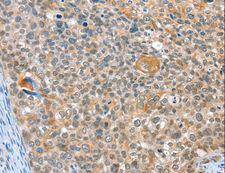 ALDOB Antibody - Immunohistochemistry of paraffin-embedded Human cervical cancer using ALDOB Polyclonal Antibody at dilution of 1:40.