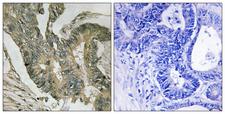 ALDOC / Aldolase C Antibody - Immunohistochemistry analysis of paraffin-embedded human colon carcinoma tissue, using ALDOC Antibody. The picture on the right is blocked with the synthesized peptide.