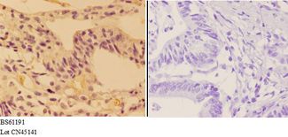 ALDOC / Aldolase C Antibody - Immunohistochemistry (IHC) analysis of ALDOC antibody in paraffin-embedded human colon carcinoma tissue at 1:50, showing cytoplasm staining. Negative control (the right) using PBS instead of primary antibody. Secondary antibody is Goat Anti-Rabbit IgG-biotin.