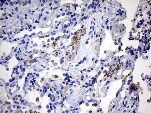 ALDP / ABCD1 Antibody - IHC of paraffin-embedded Carcinoma of Human lung tissue using anti-ABCD1 mouse monoclonal antibody. (Heat-induced epitope retrieval by 10mM citric buffer, pH6.0, 120°C for 3min).