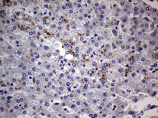 ALDP / ABCD1 Antibody - Immunohistochemical staining of paraffin-embedded Carcinoma of Human liver tissue using anti-ABCD1 mouse monoclonal antibody. (Heat-induced epitope retrieval by 1mM EDTA in 10mM Tris buffer. (pH8.5) at 120°C for 3 min. (1:250)