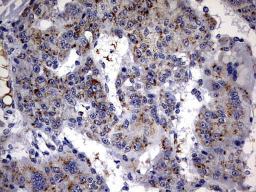 ALDP / ABCD1 Antibody - IHC of paraffin-embedded Carcinoma of Human liver tissue using anti-ABCD1 mouse monoclonal antibody. (Heat-induced epitope retrieval by 10mM citric buffer, pH6.0, 120°C for 3min).