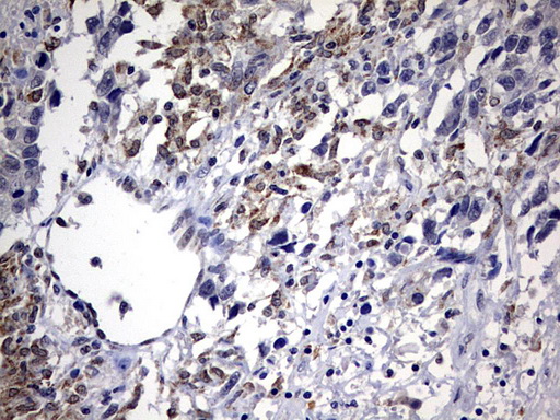 ALDP / ABCD1 Antibody - IHC of paraffin-embedded Adenocarcinoma of Human ovary tissue using anti-ABCD1 mouse monoclonal antibody. (Heat-induced epitope retrieval by 10mM citric buffer, pH6.0, 120°C for 3min).