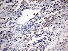 ALDP / ABCD1 Antibody - IHC of paraffin-embedded Adenocarcinoma of Human ovary tissue using anti-ABCD1 mouse monoclonal antibody. (Heat-induced epitope retrieval by 10mM citric buffer, pH6.0, 120°C for 3min).