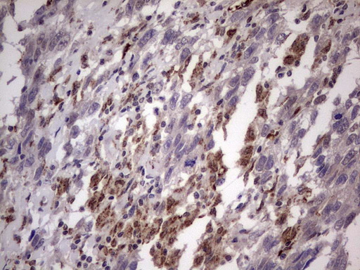 ALDP / ABCD1 Antibody - IHC of paraffin-embedded Adenocarcinoma of Human ovary tissue using anti-ABCD1 mouse monoclonal antibody. (Heat-induced epitope retrieval by 1 mM EDTA in 10mM Tris, pH8.5, 120°C for 3min).