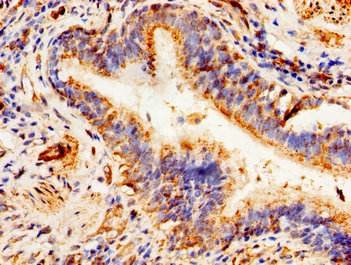ALDP / ABCD1 Antibody - Immunohistochemistry image of paraffin-embedded human lung cancer at a dilution of 1:100