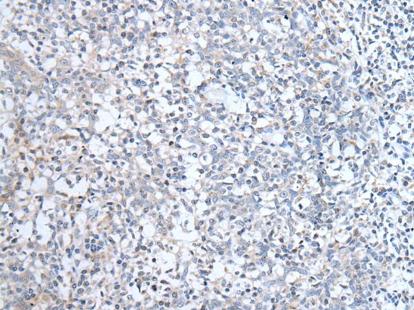 ALDP / ABCD1 Antibody - Immunohistochemistry of paraffin-embedded Human tonsil tissue  using ABCD1 Polyclonal Antibody at dilution of 1:80(×200)